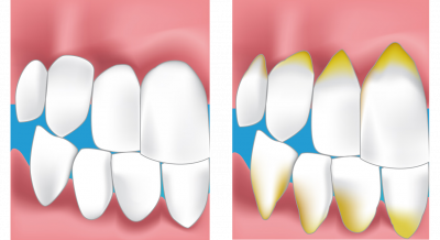 douleurs dent dentiste colomiers
