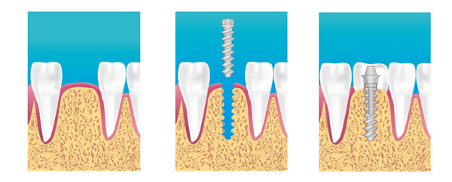 protocole implant dentaire dentiste colomiers